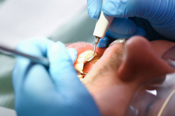Best Emergency Dental Extractions in Piedmont, SD