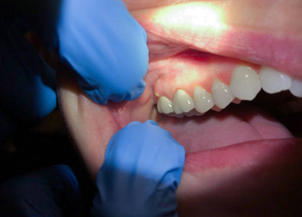 Best Emergency Dentist for Knocked-Out Tooth in Piedmont, SD